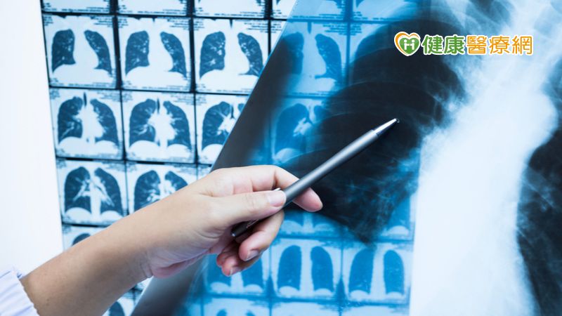 推廣低劑量電腦斷層篩檢　改善肺癌高死亡率
