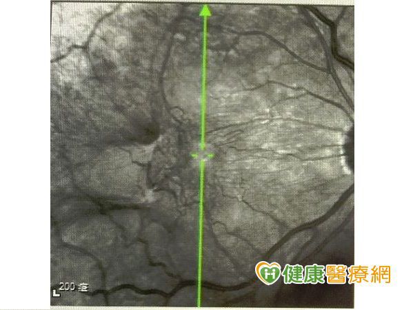  1-平面圖可看到黃班部皺成一團，此病人矯正視力僅餘0.1。