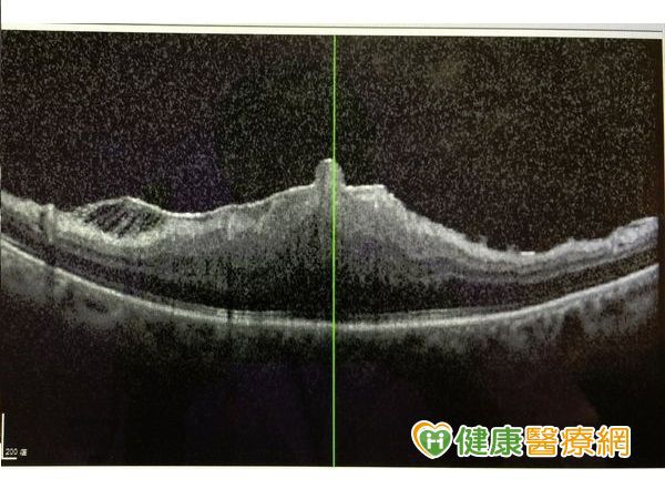  2-OCT切面可見其高高隆起，通常皺褶撕除後仍改善不多。