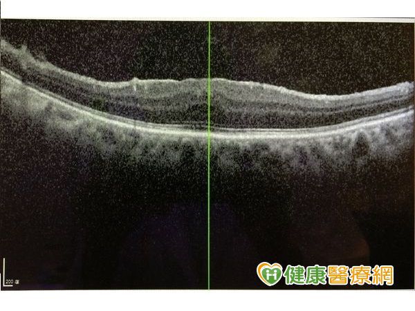 4-OCT斷層也恢復良好，每個月還在進步中，通常手術後至半年左右都還會進步。