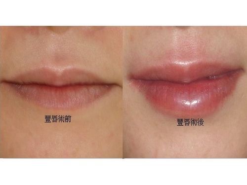 微整改善面相 薄唇女丰唇桃花旺