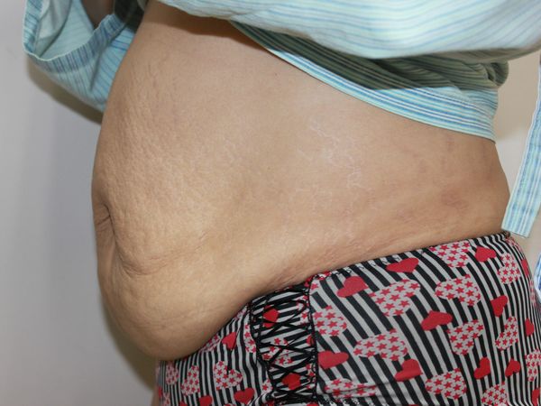 妙齡媽卻有阿嬤肚　腹部拉皮可回春