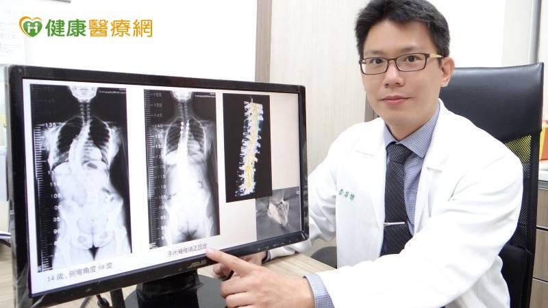 奇美醫學中心骨科部主治醫師李易儒說明：14歲的小連（化名）屬重度側彎，骨科部、脊椎和神經外科團隊，利用麻醉與神經監控系統及3D導航協助下進行骨釘植入，術後姿勢與背痛情況均有明顯改善