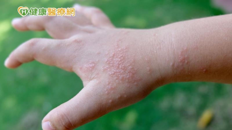 富貴手、汗皰疹纏身　醫：「三不」良方解決手部濕疹