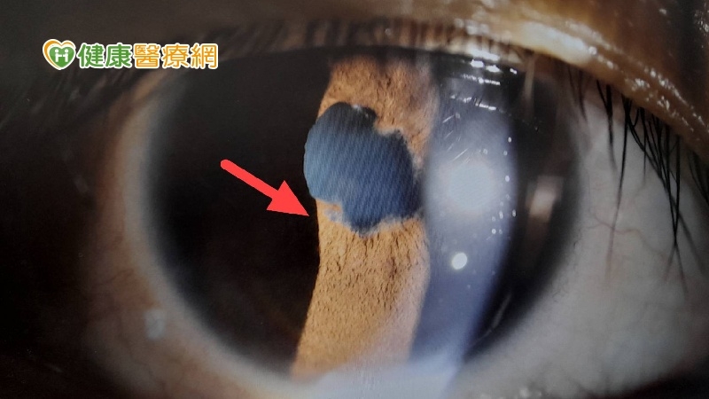 急性虹彩炎通常單眼發作，眼睛疼痛、畏光、眼睛紅、視力模糊。