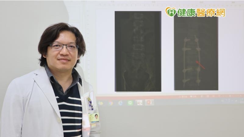 黃漢仁主任強調腰椎意外骨折時，正確判斷與選擇合適開刀方式，配合積極復健有機會避免永久癱瘓。