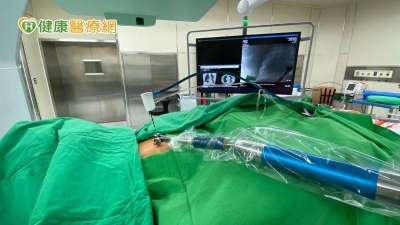 肺癌治療新里程　「一站式」無創微波消融手術保肺