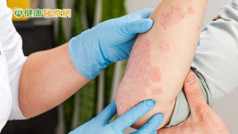 乾癬症狀表現相當多樣化，患者也常因此忽略乾癬的非典型症狀。