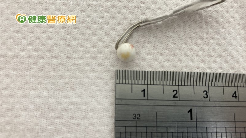 醫師利用自製迴紋針塑型之勺狀器械，在不傷害外耳道的情況下，小心翼翼的從上端繞過BB彈，從內側往外側勾出。