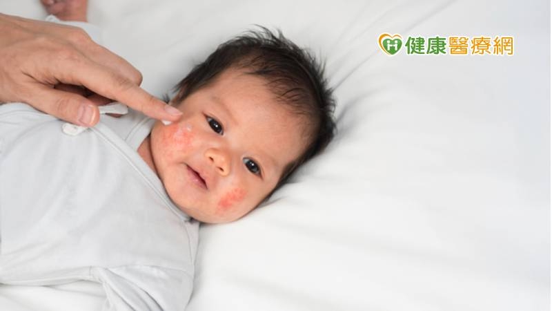 王怡人主任說明，衛福部已核准生物製劑可使用於6歲以上兒童與成人中重度異位性皮膚炎做為精準治療，精準調節免疫抑制第二型發炎反應，安全性較高又能達到減少癢感及重建皮膚障蔽的功能，不需頻繁每天吃藥及抽血監測。