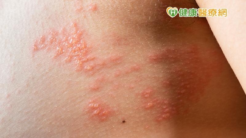 除了養成良好的生活習慣，保持身體的抵抗力之外，接種帶狀疱疹疫苗也是一個新時代的武器。
