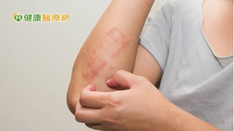 其實不僅COVID-19疫苗，其他如流感疫苗等也會導致過敏皮疹，若之前有氣喘、過敏性鼻炎、過敏性結膜炎、慢性蕁麻疹等過敏體質的人，比較容易對疫苗過敏。