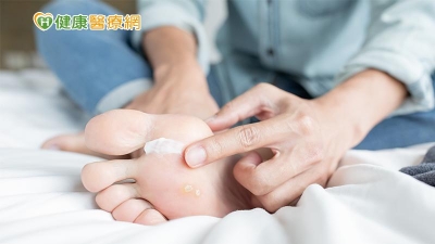 梅雨讓你「香港腳」復發了嗎？醫師：康復後繼續擦藥1～2週
