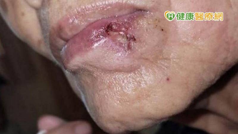 皮膚癌初期往往因不痛不癢毫無症狀，被民眾誤以為是黑斑、痣，或是不小心弄到的小傷口而延誤治療。