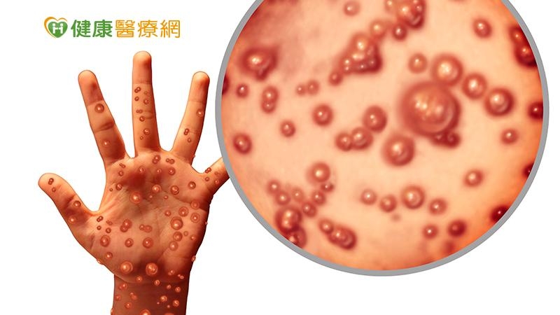 莊人祥22日表示，猴痘將增列入第2類法定傳染病。