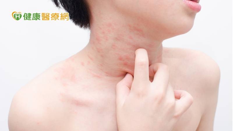 鄭百珊主治醫師提及，急性、溼疹樣病灶較常見於兒童，雖然成人型也會出現許多此類變化，但相較於兒童，成人異位性皮膚炎除了急性溼疹樣變化以外，臨床還有表皮增生、苔癬畫、癢疹等慢性病灶表現。