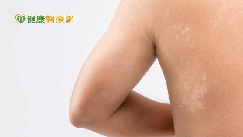 汗斑又稱變色糠疹，它在南台灣濕熱的夏天非常普遍發生。