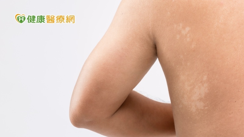 夏天一到就開始長汗斑？　皮膚醫解析「治療守則」