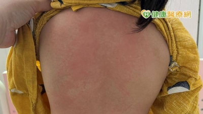 4歲女童染疫康復突休克　醫：MIS-C恐是川崎病極端形式