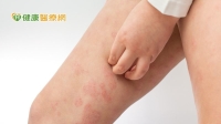 皮膚反覆濕疹，內服外用都治不好，竟是「惡性皮膚T細胞淋巴瘤」