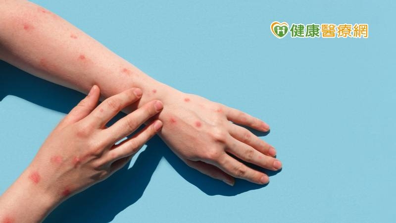 猴痘疫情主要集中在親密接觸者，同性間性行為者，與新冠肺炎的傳播方式不同，目前並無大規模接種疫苗的必要。