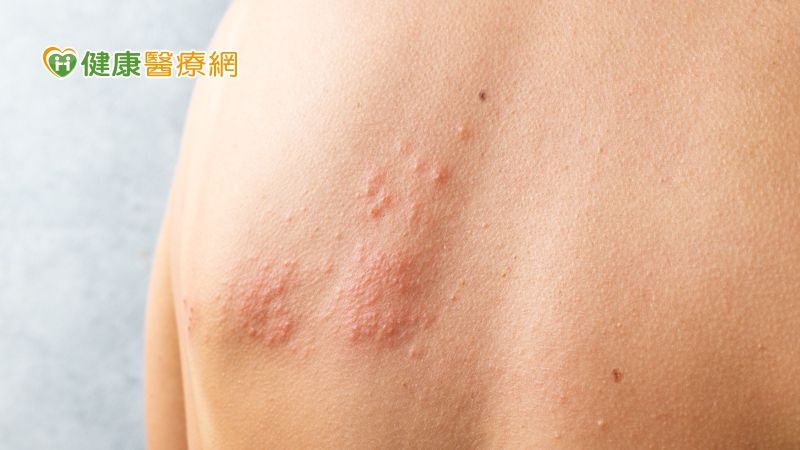 年老與免疫缺陷是帶狀疱疹最重要的危險因素，50歲以上發生率急遽上升，隨著年紀越長，發生機率越高。
