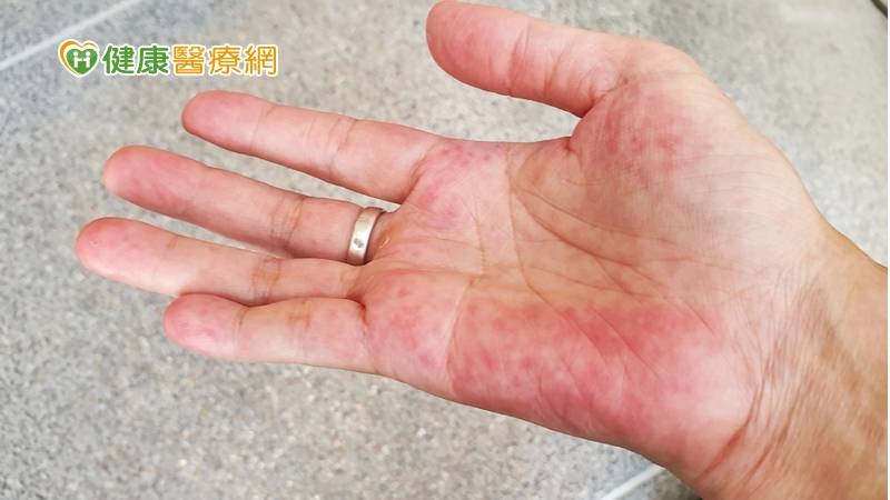 系統性紅斑性狼瘡患者以年輕女性居多，有些病人因需長時間使用大劑量類固醇，臉會變圓、體重增加，在健康上，可能會造成提早白內障、皮膚容易瘀青、骨質疏鬆、失眠等併發症，對患者而言，雖然吃藥可以控制疾病活動度，但卻會對生活品質有相當大的影響
