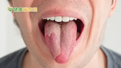 舌頭上有地圖？　「這體質」的人身體常出狀況　1周刷舌10次就夠了