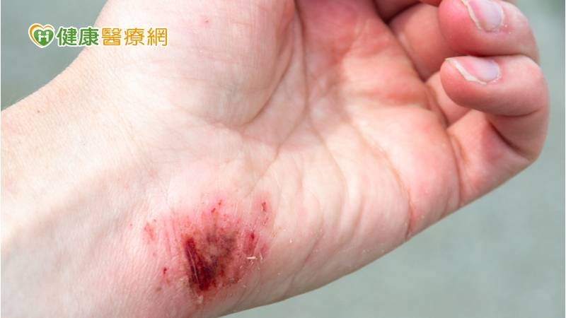 處理海鮮被刺傷　中年男「壞死性筋膜炎」險致命