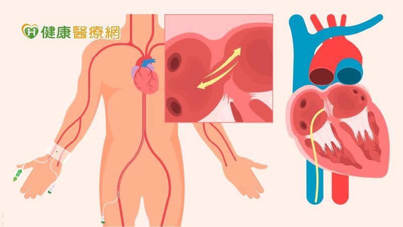 三成中風患者恐二度中風！不明原因中風需警覺　恐為卵圓孔未閉合