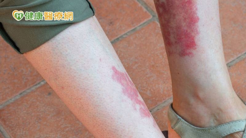 中年男突然肢體癱瘓　竟是過敏「血管炎」