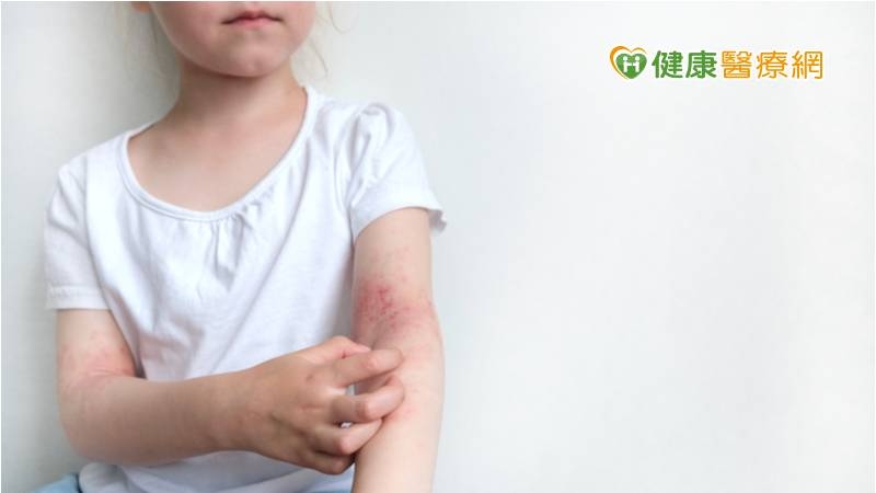 異位性皮膚炎癢到抓破皮　日常「3大治療產品」助緩解