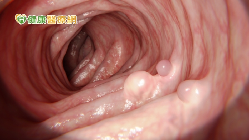 女星切除12顆大腸瘜肉，隔年又長6顆！　多久要做一次大腸鏡？