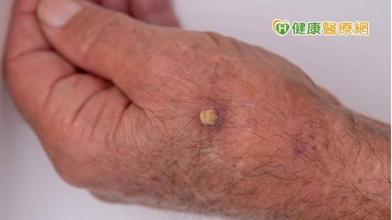 白肉底的人注意！小心皮膚會長角　摸到突出錐狀快就醫