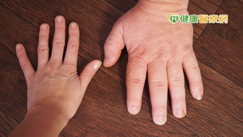 治療肢端肥大症新契機　新型注射器有助降低疼痛