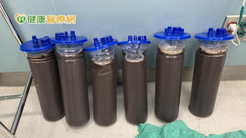 超大卵巢惡性腫瘤重達18公斤！　與直腸、膀胱全黏一起