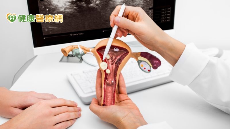子宮切除對女性有「這些」影響　子宮肌瘤不一定要切除子宮