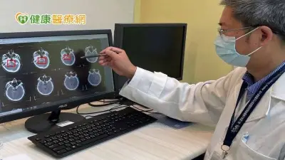 30秒內檢出顱內出血！　「AI偵測系統」爭取腦中風黃金治療期