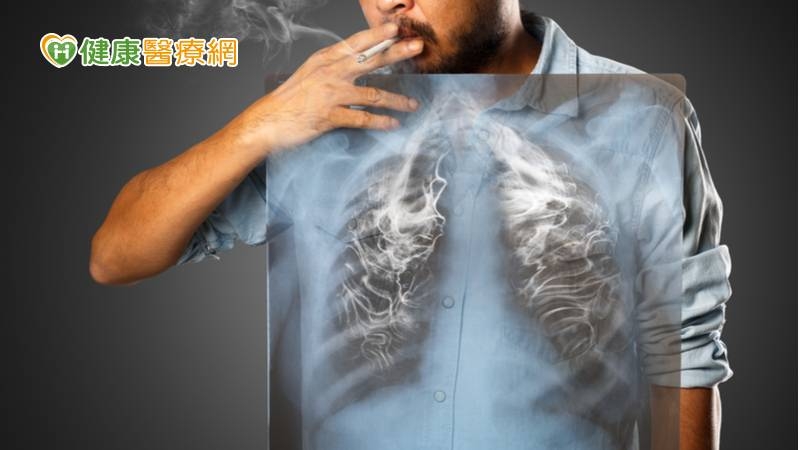 「2對象」納公費補助第五癌篩檢　高達8成檢出早期肺癌