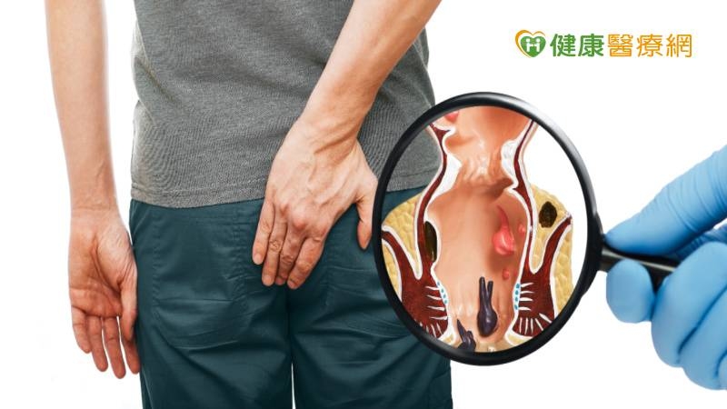 痔瘡脫垂推不回　「1治療方式」傷口小、當日可返家