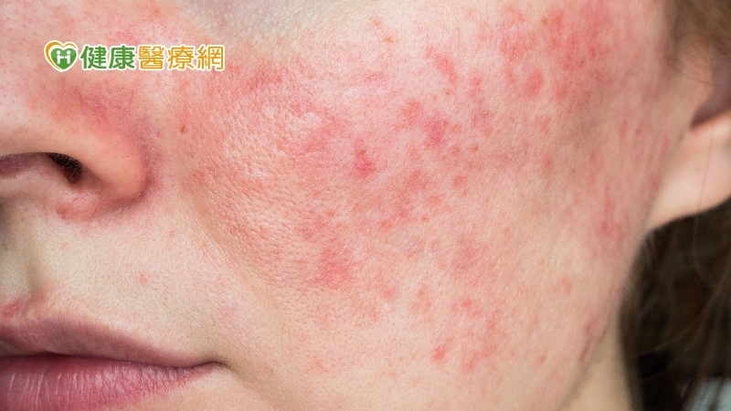類固醇上癮　皮膚炎變酒糟怎麼辦？