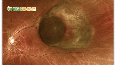 視線扭曲竟是罕見「眼睛長腫瘤」　十年內半數病患恐死亡