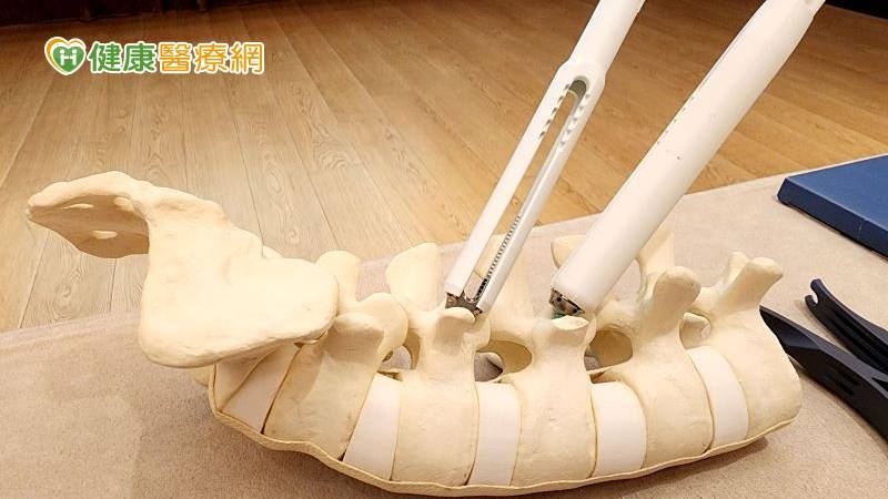 35歲男背痛到無法下床　脊椎微創併一次性手術工具擺脫