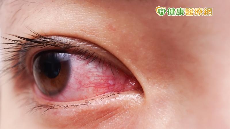 戴隱形眼鏡習慣不良　角膜感染會潰瘍！