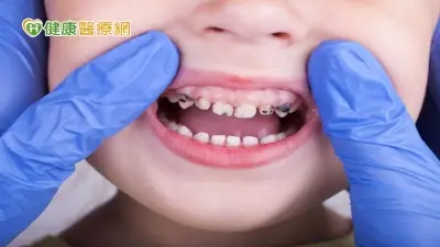 兒童「6大原因」致蛀牙　醫授預防關鍵