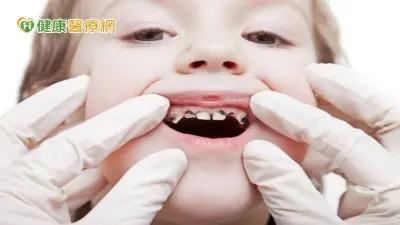 不滿三歲竟14顆蛀牙　女童因「這習慣」戒不掉！