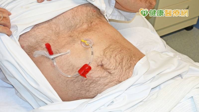 捨棄鼻胃管　七旬嬤從「這」找回尊嚴！