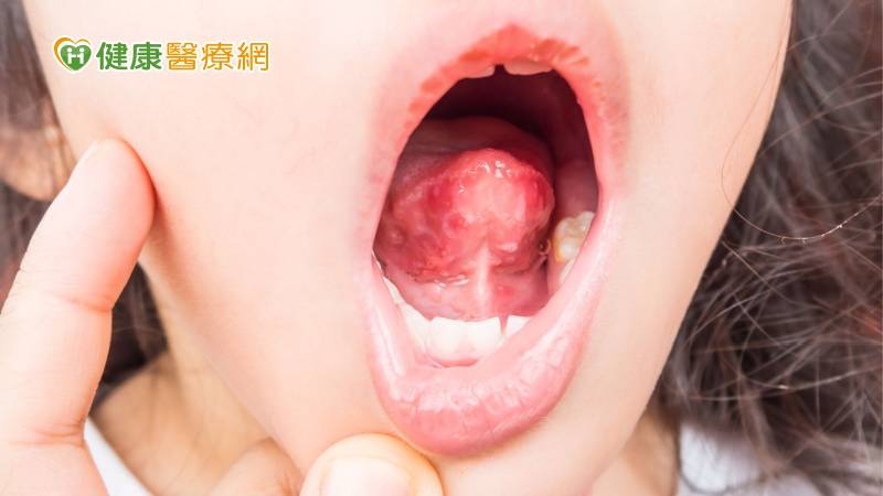 小孩腸病毒吃不下怎辦？　醫：開放「這些軟食物」應急