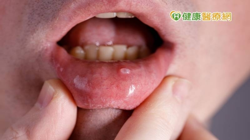 嘴破不一定是火氣大！口腔癌前病變5大症狀　1男輕忽住院天數多6倍