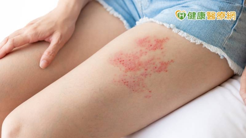 皮蛇好發高峰期！醫警告「1情況」就可能發病　預防方式看這